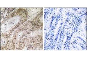 Immunohistochemistry analysis of paraffin-embedded human colon carcinoma, using RDM1 Antibody. (RDM1 抗体  (AA 118-167))