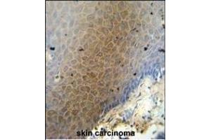 CEP70 antibody (Center) (ABIN654603 and ABIN2844302) immunohistochemistry analysis in formalin fixed and paraffin embedded human skin carcinoma followed by peroxidase conjugation of the secondary antibody and DAB staining. (CEP70 抗体  (AA 309-338))
