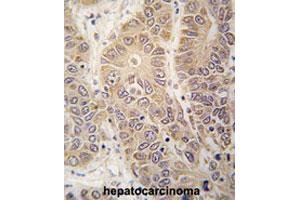 Formalin-fixed and paraffin-embedded human hepatocarcinomareacted with HARS polyclonal antibody , which was peroxidase-conjugated to the secondary antibody, followed by AEC staining. (HARS1/Jo-1 抗体  (N-Term))