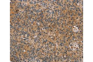 Immunohistochemistry of Human cervical cancer using TAC1 Polyclonal Antibody at dilution of 1:25 (TAC1 抗体)