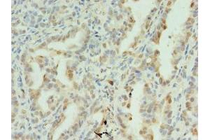 Immunohistochemistry of paraffin-embedded human lung cancer using ABIN7170902 at dilution of 1:100 (SDHC 抗体  (AA 30-62))