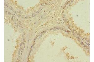 Immunohistochemistry of paraffin-embedded human prostate cancer using ABIN7147148 at dilution of 1:100 (CD276 抗体  (AA 29-200))