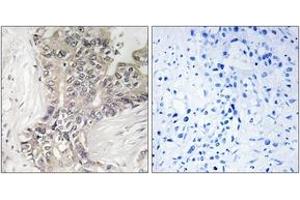 Immunohistochemistry analysis of paraffin-embedded human liver carcinoma tissue, using B3GALTL Antibody. (B3GALTL 抗体  (AA 449-498))