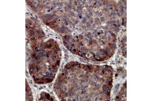 Immunohistochemical analysis of TRAPPC5 staining in human lung cancer formalin fixed paraffin embedded tissue section. (TRAPPC5 抗体)