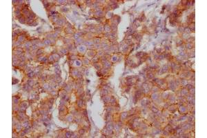 IHC image of ABIN7127403 diluted at 1:100 and staining in paraffin-embedded human breast cancer performed on a Leica BondTM system. (Recombinant CD46 抗体)