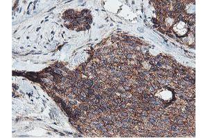 Immunohistochemical staining of paraffin-embedded Adenocarcinoma of Human breast tissue using anti-NPTN mouse monoclonal antibody. (NPTN 抗体)