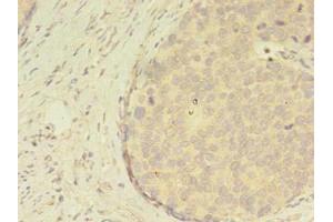 Immunohistochemistry of paraffin-embedded human gastric cancer using ABIN7144805 at dilution of 1:100