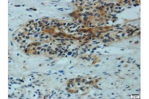 Immunohistochemistry of paraffin-embedded human cervical carcinoma using MMP1 antibody. (MMP1 抗体)