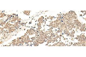 Immunohistochemistry of paraffin-embedded Human lung cancer tissue using GPR139 Polyclonal Antibody at dilution of 1:50(x200) (GPR139 抗体)