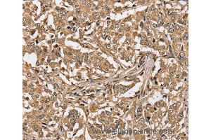 Immunohistochemistry of Human liver cancer using PPP1CC Polyclonal Antibody at dilution of 1:40 (PPP1CC 抗体)