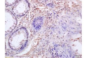 Formalin-fixed and paraffin embedded human colon carcinoma labeled with Anti-IRF3 Polyclonal Antibody, Unconjugated (ABIN682588) at 1:200 followed by conjugation to the secondary antibody and DAB staining (IRF3 抗体  (AA 51-150))