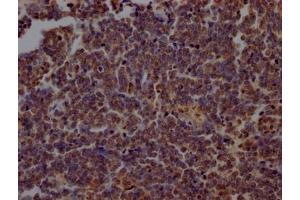 IHC image of ABIN7163739 diluted at 1:200 and staining in paraffin-embedded human lung cancer performed on a Leica BondTM system. (PARP1 抗体  (AA 324-541))