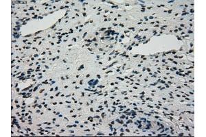 Immunohistochemical staining of paraffin-embedded Adenocarcinoma of breast tissue using anti-STK39 mouse monoclonal antibody. (STK39 抗体)