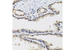 Immunohistochemistry of paraffin-embedded human prostate using PLA2G7 antibody. (PLA2G7 抗体)