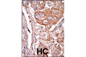 Formalin-fixed and paraffin-embedded human cancer tissue reacted with the primary antibody, which was peroxidase-conjugated to the secondary antibody, followed by DAB staining. (FGF4 抗体  (C-Term))