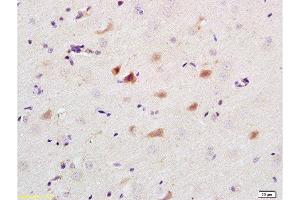Formalin-fixed and paraffin embedded human colon carcinoma labeled with Anti-Caspase-9 Polyclonal Antibody, Unconjugated 1:200 followed by conjugation to the secondary antibody and DAB staining