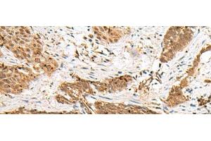Immunohistochemistry of paraffin-embedded Human esophagus cancer tissue using NUP58 Polyclonal Antibody at dilution of 1:50(x200) (NUPL1 抗体)