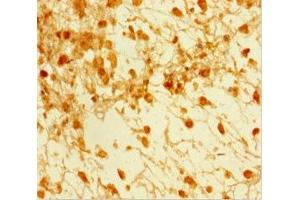 Immunohistochemistry of paraffin-embedded human melanoma using ABIN7160242 at dilution of 1:100 (SMAD5 抗体  (AA 1-209))