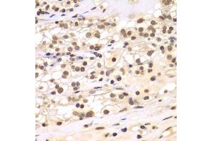 Immunohistochemistry of paraffin-embedded human kidney cancer using ULK4 antibody (ABIN5975557) at dilution of 1/100 (40x lens). (ULK4 抗体)