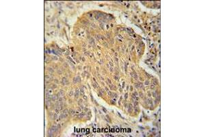 PSMD7 Antibody immunohistochemistry analysis in formalin fixed and paraffin embedded human lung carcinoma followed by peroxidase conjugation of the secondary antibody and DAB staining. (PSMD7 抗体  (C-Term))