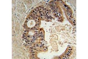 DYRK1A Antiboty immunohistochemistry analysis in formalin fixed and paraffin embedded human prostate carcinoma. (DYRK1A 抗体  (AA 107-136))