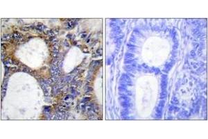 Immunohistochemistry analysis of paraffin-embedded human colon carcinoma tissue, using Collagen I alpha2 Antibody. (COL1A2 抗体  (AA 471-520))