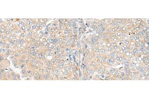 Immunohistochemistry of paraffin-embedded Human liver cancer tissue using CAMK2A Polyclonal Antibody at dilution of 1:55(x200) (CAMK2A 抗体)