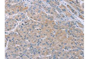 The image on the left is immunohistochemistry of paraffin-embedded Human liver cancer tissue using ABIN7192258(SAMD4B Antibody) at dilution 1/20, on the right is treated with synthetic peptide. (SAMD4B 抗体)