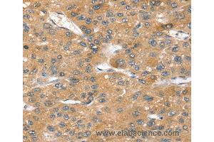 Immunohistochemistry of Human breast cancer using SORT1 Polyclonal Antibody at dilution of 1:40