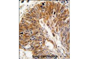 Formalin-fixed and paraffin-embedded human lung carcinoma tissue reacted with PSMD11 antibody , which was peroxidase-conjugated to the secondary antibody, followed by DAB staining. (PSMD11 抗体  (C-Term))