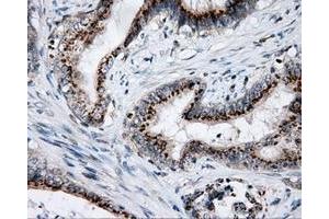 Immunohistochemical staining of paraffin-embedded Adenocarcinoma of colon tissue using anti-LIPG mouse monoclonal antibody. (LIPG 抗体)