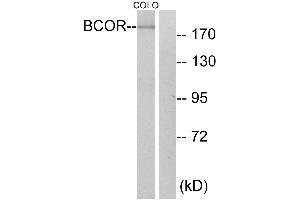 Immunohistochemistry analysis of paraffin-embedded human breast carcinoma tissue using BCOR antibody. (BCOR 抗体)