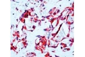 Formalin fixed paraffin embedded human angiosarcoma stained with Flt-1 antibody (FLT1 抗体  (C-Term))