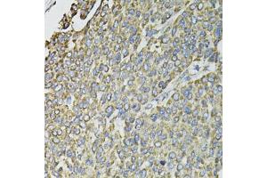 Immunohistochemistry of paraffin-embedded human liver cancer using RASSF1 antibody (ABIN6293520) at dilution of 1:100 (40x lens). (RASSF1 抗体)