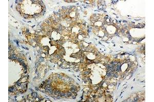 IHC-P: Calpain 1 antibody testing of human breast cancer tissue (Calpain 抗体  (Catalytic Subunit))