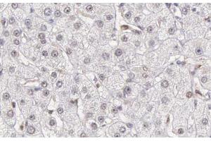 ABIN6266502 at 1/200 staining human liver carcinoma tissue sections by IHC-P. (Caspase 10 抗体)