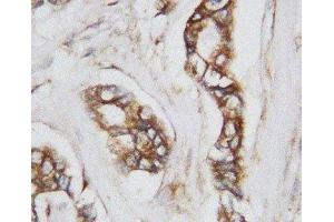 IHC-P: CDC42 antibody testing of human breast cancer tissue (CDC42 抗体  (Middle Region))