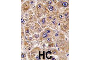 Formalin-fixed and paraffin-embedded human hepatocellular carcinoma reacted with ALDH5A1 polyclonal antibody  , which was peroxidase-conjugated to the secondary antibody, followed by DAB staining. (ALDH5A1 抗体  (C-Term))