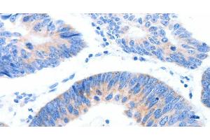Immunohistochemistry of paraffin-embedded Human colon cancer tissue using MUC3A Polyclonal Antibody at dilution 1:60 (MUC3A 抗体)
