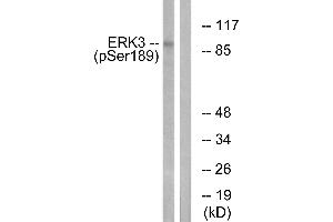 Immunohistochemistry analysis of paraffin-embedded human breast carcinoma tissue using ERK3 (Phospho-Ser189) antibody.