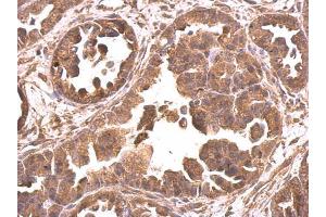 IHC-P Image EIF4A2 antibody detects EIF4A2 protein at cytosol on human ovarian carcinoma by immunohistochemical analysis. (EIF4A2 抗体)