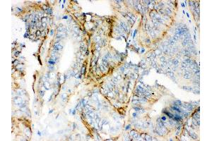 Anti-PKLR Picoband antibody, IHC(P) IHC(P): Human Intestinal Cancer Tissue (PKLR 抗体  (C-Term))