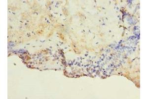 Immunohistochemistry of paraffin-embedded human breast cancer using ABIN7172926 at dilution of 1:100 (TM4SF1 抗体  (AA 115-161))