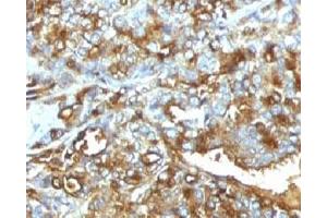 Immunohistochemistry (Formalin-fixed Paraffin-embedded Sections) (IHC (fp)) image for anti-Mucin 1 (MUC1) antibody (ABIN3025281)