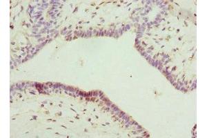 Immunohistochemistry of paraffin-embedded human breast cancer using ABIN7156859 at dilution of 1:100 (IL22RA2 抗体  (AA 22-231))