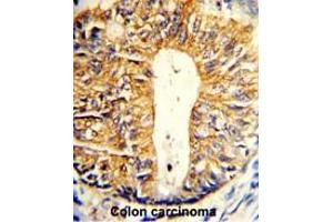 Formalin-fixed and paraffin-embedded human colon carcinoma reacted with Villin-1 Antibody (N-term), which was peroxidase-conjugated to the secondary antibody, followed by DAB staining. (Villin 1 抗体  (N-Term))