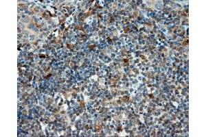Immunohistochemical staining of paraffin-embedded Carcinoma of liver tissue using anti-LIPG mouse monoclonal antibody. (LIPG 抗体)