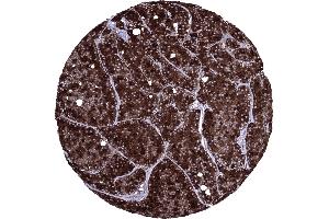 Acinar cell carcinoma of the pancreas exhibiting a strong CELA3B immunostaining of all tumor cells (Recombinant Elastase 3B 抗体  (AA 82-238))