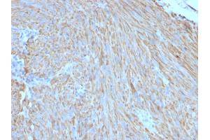 Formalin-fixed, paraffin-embedded human GIST stained with CD117 Mouse Monoclonal Antibody (C117/370). (KIT 抗体)