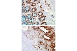 Immunochemical staining of human colon cancer with HSP90B1 monoclonal antibody, clone H9010  at 100,000 fold dilution.